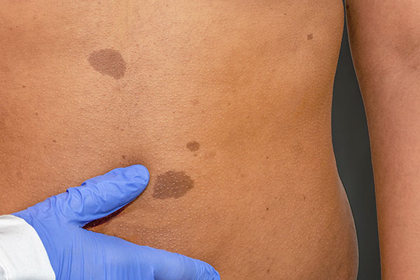 Photo of coffee marks on skin
