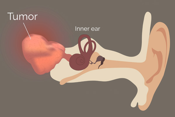 Graphic showing inner ear tumor
