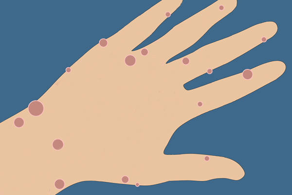 graphic showing schwannomatosis symptoms on hand